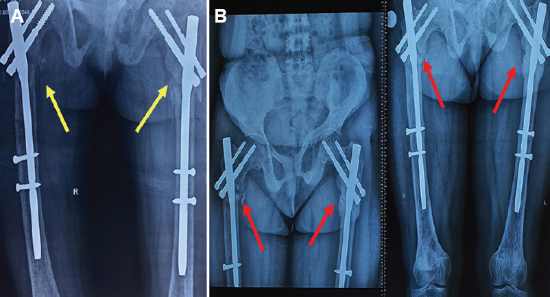 (A) Immediate post-operative radiograph with implant in situ (yellow arrow) and (B) fracture completely healed at one year (red arrows).